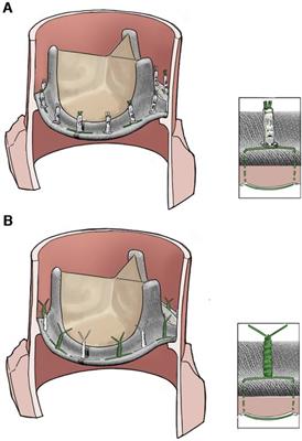 Automated titanium fastener vs. hand-tied knots for prosthesis fixation in infective endocarditis